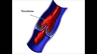 Thrombose Ursachen Anzeichen Hilfe und Therapie [upl. by Blunk]