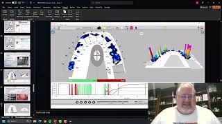 TScan implementation 3 cases [upl. by Aldas]