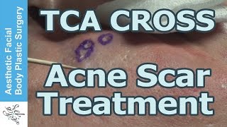 Live Surgery amp Discussion with 80 Tricholoroacetic Acid  TCA CROSS for Deep Ice Pick Acne Scars [upl. by Haswell399]