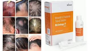 Brintop F 10 Topical Solution Minoxidil amp Frastende Topical Soluton [upl. by Mirna498]