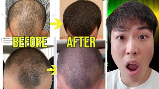 Bald People REVERSE Hair Loss After Adding Microneedling Incredible BeforeAfter Results [upl. by Adnocahs]