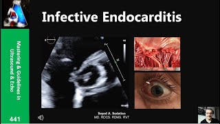 Infective Endocarditis  public [upl. by Mahla]