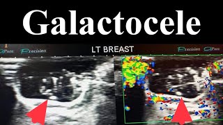 Galactocele  Lactocele  Benign Breast Lesion [upl. by Marcellus739]