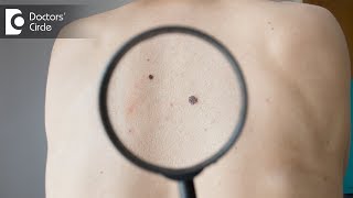 Is it normal for a mole to suddenly appear on skin  Dr Urmila Nischal [upl. by Jewett]