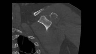 Radiology Rounds CT of humeral fracture [upl. by Alva]