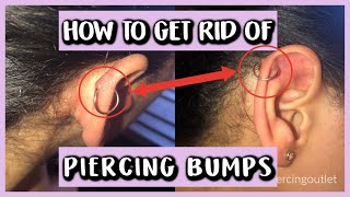 HOW TO GET RID OF PIERCING BUMPS [upl. by Gronseth572]