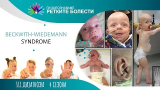 23  Beckwith Wiedemann syndrome BWS [upl. by Allenod954]