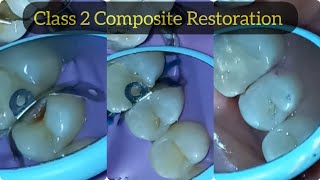 Composite Restoration of Class 2 Cavity in Upper Premolar  Posterior Composite Filling [upl. by Patricia733]