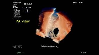 Ostium secundum ASD amp Atrial septal aneurysm  3D echocardiography [upl. by Vod913]