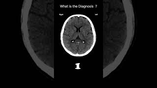 Fissures  CT brain CT Brain Anatomy CSF spaces Quiz 16 radiologychannel007 [upl. by Sinnylg680]