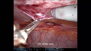 HD4K ROBOTIC Ventral  umbilical hernia repair [upl. by Janicki]