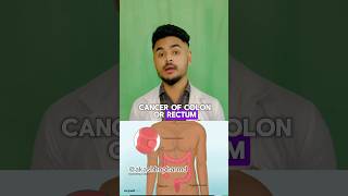 Colorectal Cancer Alert 🚨 Pharmd colorectalcancer cancer colorectalcancerawareness [upl. by Nahrut]