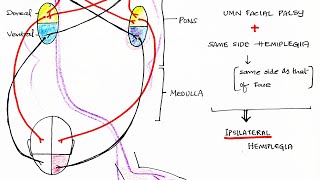 Hemiplegia CVA  Stroke  Theory amp Clinical discussion [upl. by Raamaj]