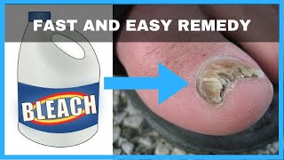 How to Get Rid of Toenail Fungus with Bleach  Toe Fungus Journey [upl. by Keen57]