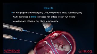 UOG video abstract on chorionic villus sampling in twin pregnancy [upl. by Verda]