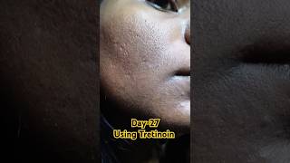 Day27 Using Tretinoin 0025 cream viralvideo tretinoin tretinoincream shorts youtubeshorts [upl. by Loggia]