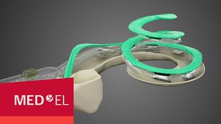 Cochlear Implant Electrodes to Fit Each Cochlea [upl. by Harimas]