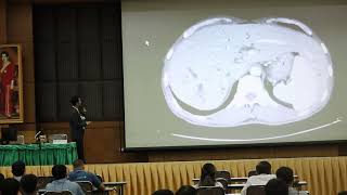 Surgical Anatomy of perihilar cholangiocarcinoma อ ภูวนัย [upl. by Lerak]