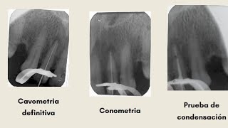 Endodoncia 22 [upl. by Mccallion]