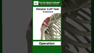 Treatment of rotator cuff tear   Dr Ujjwal K Debnath [upl. by Perlie]