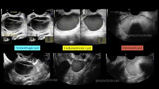 Hemorrhagic vs Endometriotic vs Dermoid cyst Recap series V2 [upl. by Asseral]