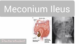 Meconium Ileus [upl. by Draner87]