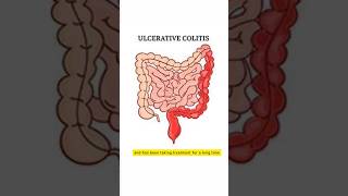 Important for Ulcerative Colitis patients [upl. by Cassil]