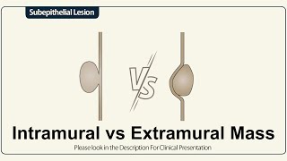 Intramural Vs Extramural Mass [upl. by Aciram]