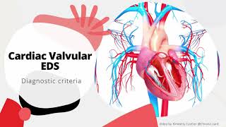 CardiacValvular Ehlers Danlos Syndrome Diagnostic Criteria [upl. by Chadd142]