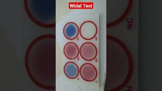 Widal Test for Typhoid and Paratyphoid Fever Salmonella Typhi and Salmonella Paratyphi [upl. by Esila]