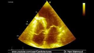 LV aneurysm with thrombus [upl. by Madel]