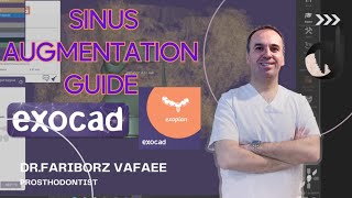 Exoplan 31 sinus augmentation guide [upl. by Odrahcir]