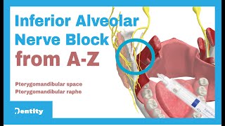 Inferior Alveolar Nerve Block  AZ [upl. by Banebrudge850]