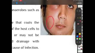 Odontogenic infections4th stage oral surgery part2 [upl. by Inor]