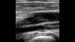 POPLITEAL VEIN FLOATING THROMBUS [upl. by Dalenna]