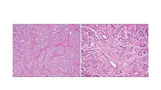 Sertoli leydig cell tumorGYNpath [upl. by Nysila]