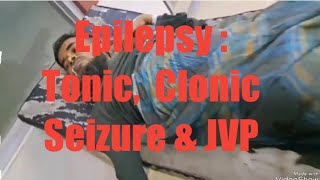 Epilepsy  Types of clonic seizureTonic amp clonic phase  JVP [upl. by Hibbs]