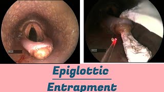 Epiglottic Entrapment [upl. by Shaylyn]