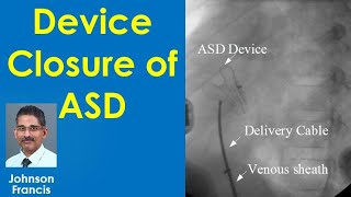 Device Closure of Atrial Septal Defect ASD [upl. by Aliwt]