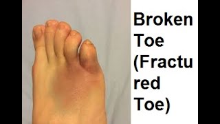 Broken Toe Fractured Toe Symptoms and Causes  Diagnosis  Treatment  Prevention healthcare [upl. by Saied624]