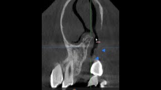 ALVEOLAR CLEFT CBCT BASICS OF INTERPRETATION [upl. by Zilada]