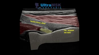 ¿Como evaluar la porción distal del bíceps en ultrasonido [upl. by Eimmaj885]