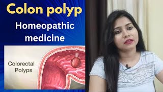 Colon polyps Bowel polyp homeopathic medicine  Colon polyps symptomscauses amp treatment  hindi [upl. by Uchida454]