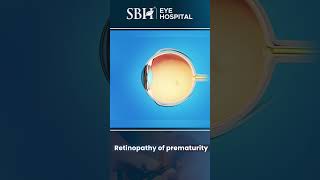 What is retinopathy of prematurity  Retinopathy of prematurity  Eye Treatment  SBH Hospital [upl. by Emyle]