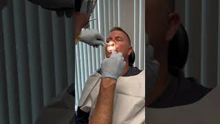 Nasal splint removal one week after Septoplasty [upl. by Ayotan]