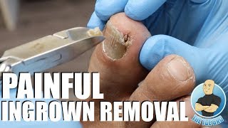 TREATING AN EXTREMELY PAINFUL INGROWN TOENAIL WITH HOW TO ADVICE [upl. by Pandolfi]