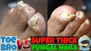 Trimming of Super Thick Fungal Nails FULL TREATMENT [upl. by Eidak]