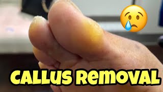 EXTREMELY SATISFYING CALLUS REMOVAL FROM THE FOOT [upl. by Nakeber]