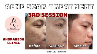 Acne Scar Treatment with Subcision amp TCA Cross  Andraneda Clinic  Philippines [upl. by Nospmoht]