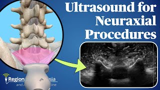 Ultrasound for Neuraxial Procedures [upl. by Aiekram]